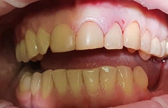 Замещение утраченного зуба имплантом