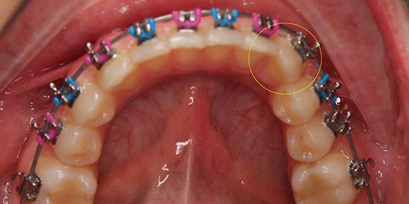 Перемещение зубов в анатомически и функционально правильное положение в процессе ортодонтического лечения