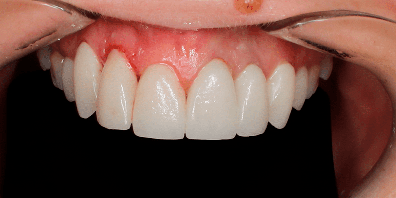 Установка виниров E-Max, пациентка обратилась с пожеланием исправить форму и цвет зубов
