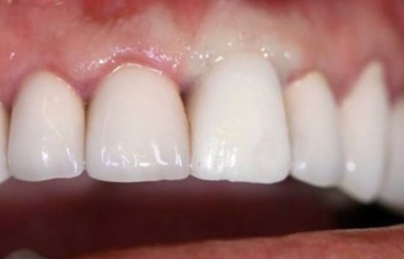 Восстановление зуба имплантатом