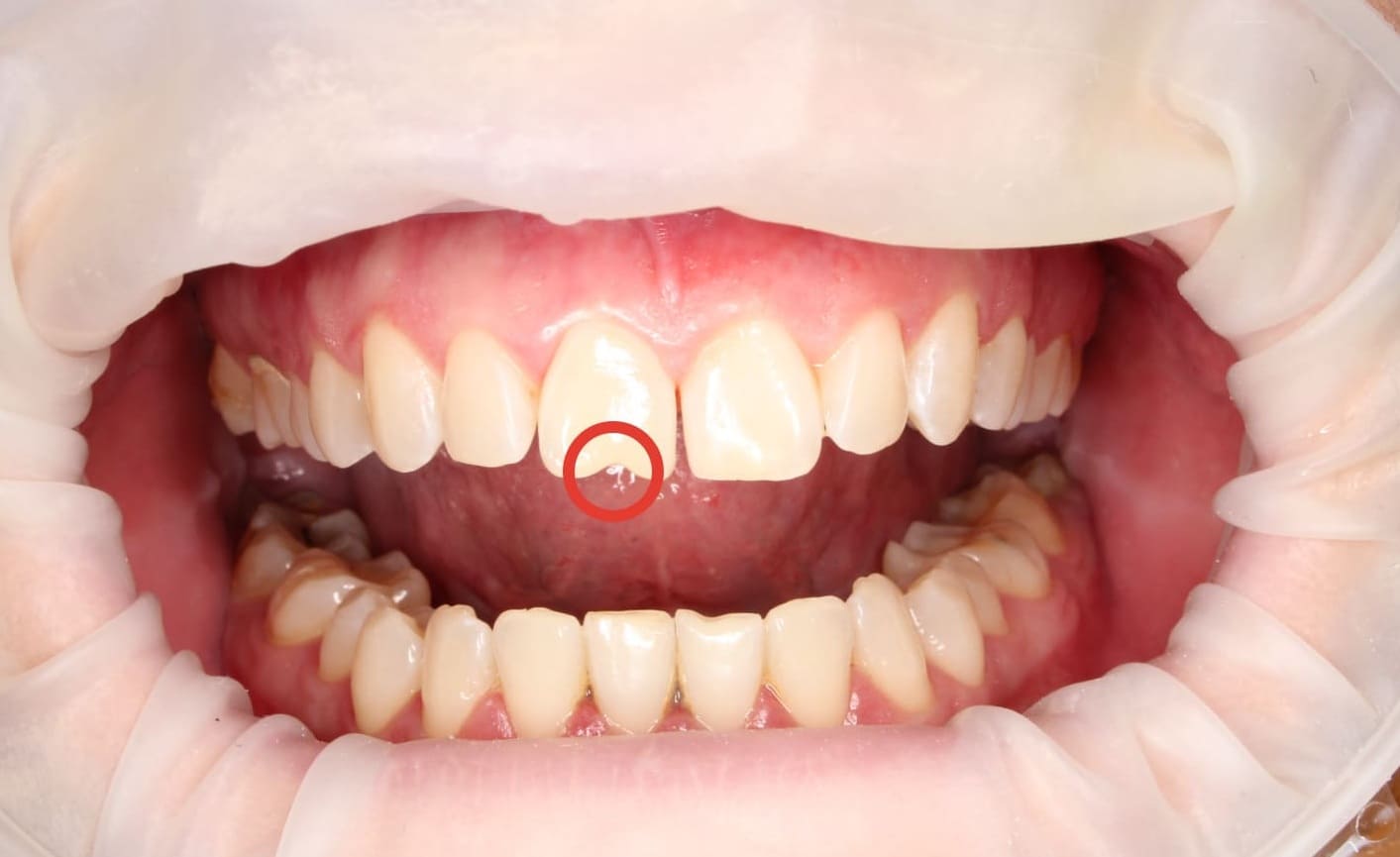 Реставрация зуба в зоне улыбки