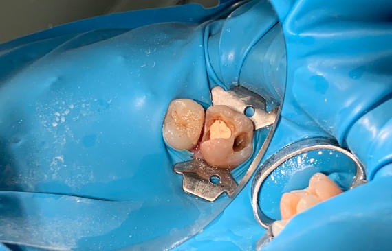 Замена дефектной пломбы 16 зуба