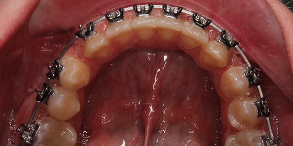 Выравнивание зубного ряда