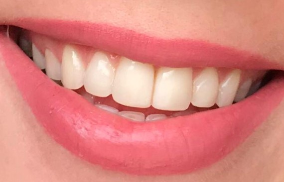 Прямая реставрация передних зубов верхней челюсти