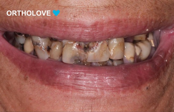Восстановление утраченных зубов на нижней и верхней челюсти по технологии все на 4