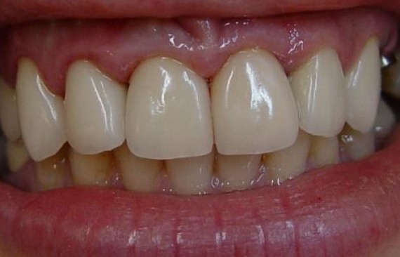 Эстетическая реставрация передних зубов верхней челюсти