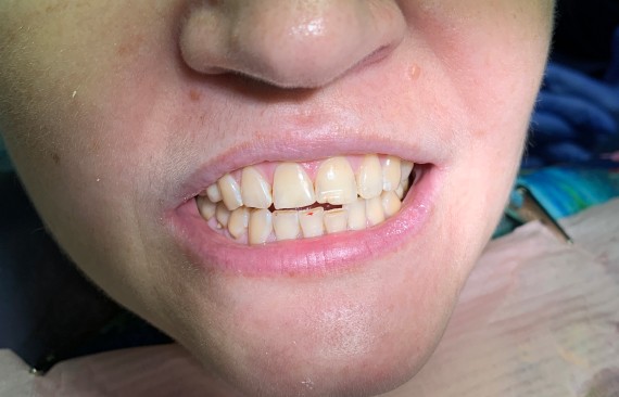 Восстановление угла коронковой части 11 зуба