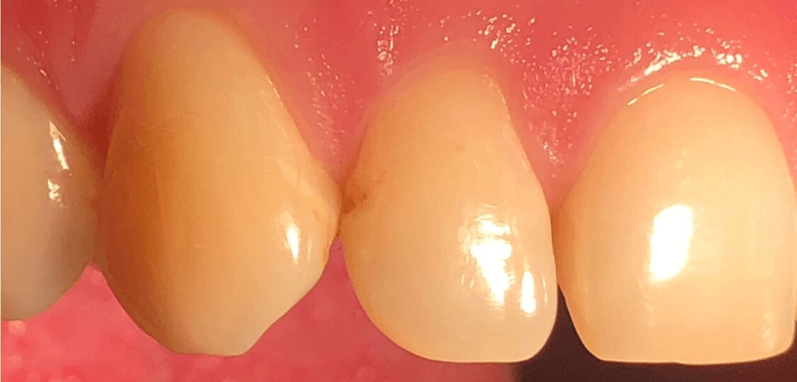 Кариес дистальный поверхности 12 зуба