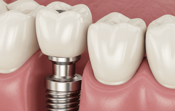 ИМПЛАНТАЦИЯ СО СКИДКОЙ 30%