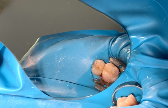 Замена дефектной пломбы 16 зуба