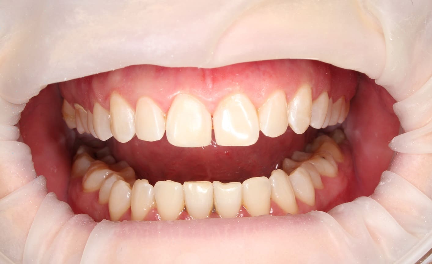 Реставрация зуба в зоне улыбки