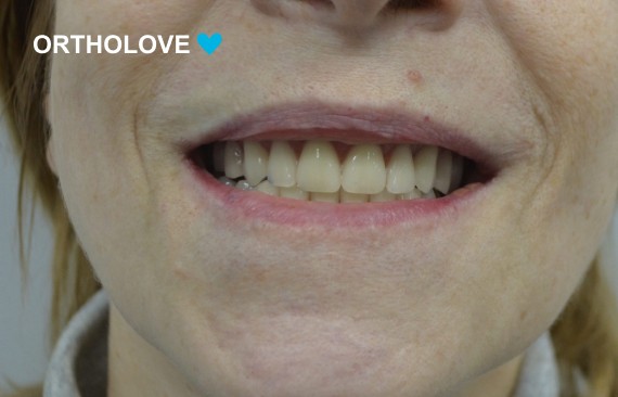 Полное восстановление зубов на нижней и верхней челюсти