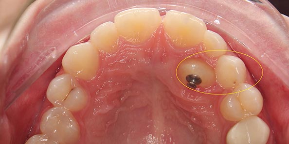 Сложное перемещение зуба в процессе лечения на элайнерах Eurokappa