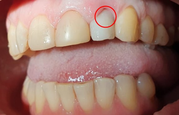 Замещение утраченного зуба имплантом