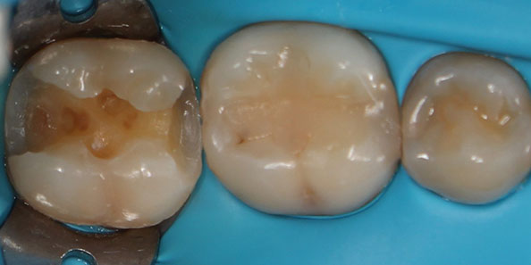 Лечение глубокого кариеса и восстановление анатомической формы зуба
