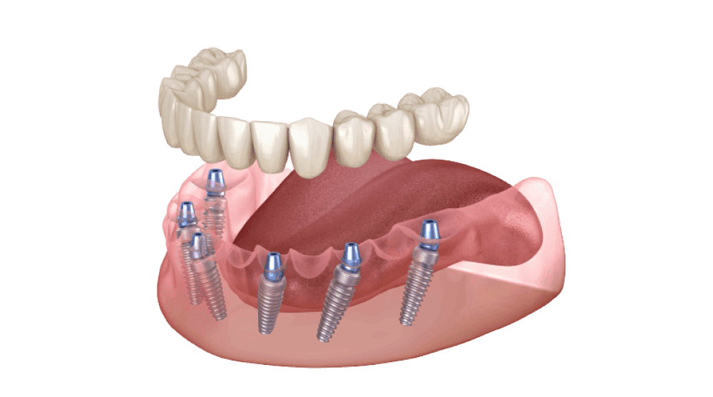 Что представляет собой имплантация зубов All-on-6