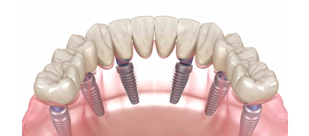 Особенности имплантации зубов All-on-6