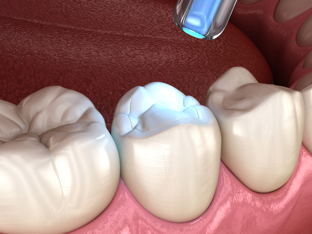 Реставрация зубов в стоматологической клинике OrthoLove