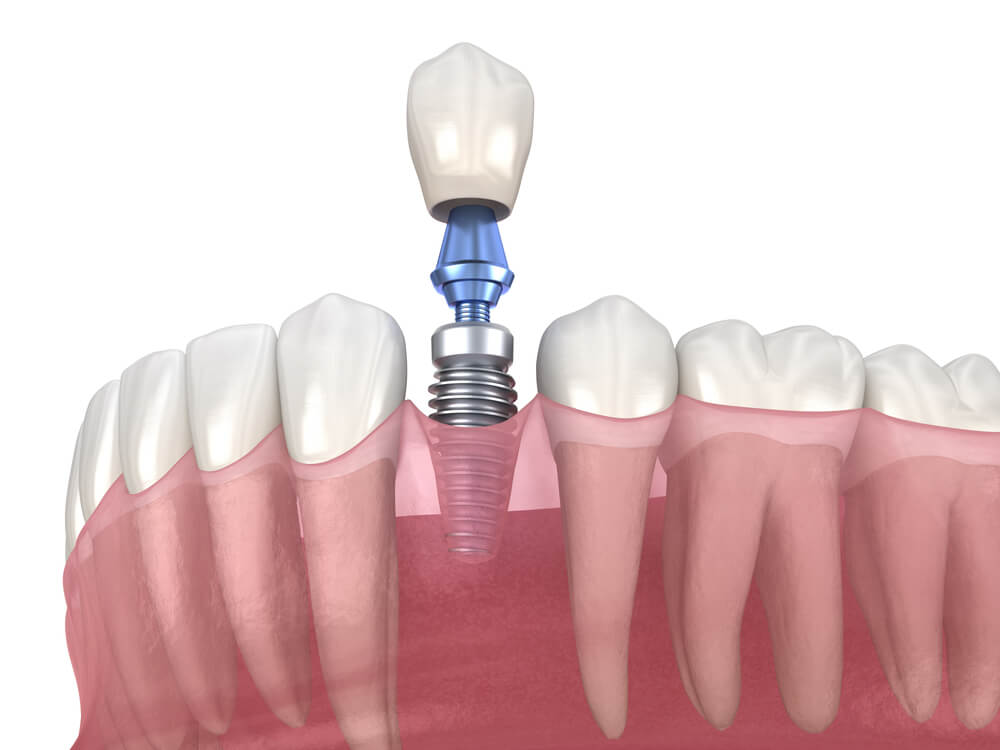 Критерии зубных имплантов