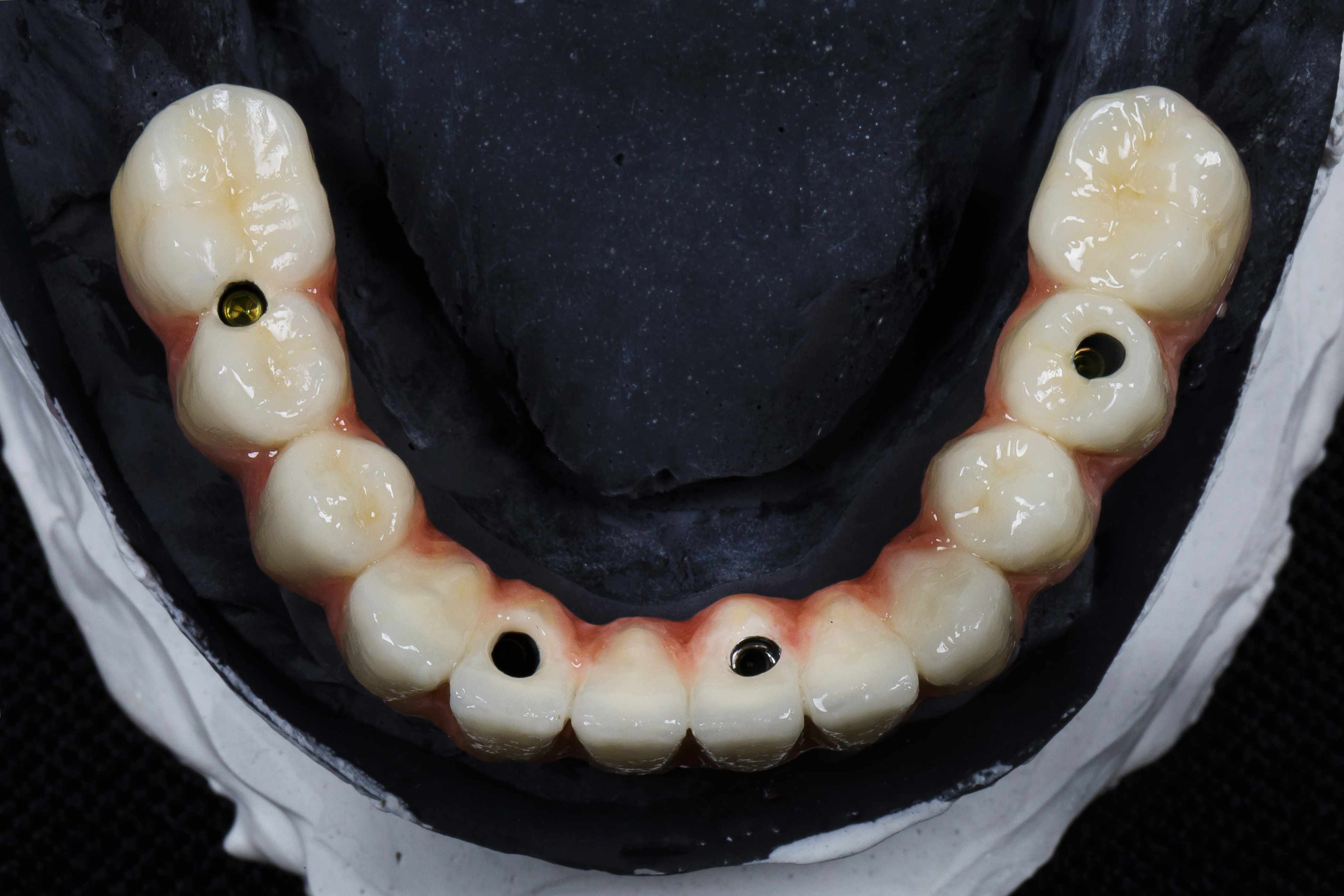 Зубной протез на имплантах при полном отсутствии зубов
