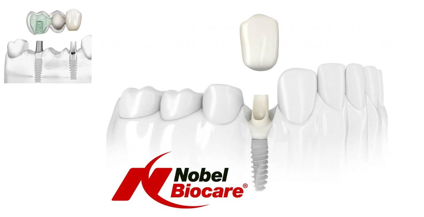 Установка импланта Nobel Biocare с коронкой
