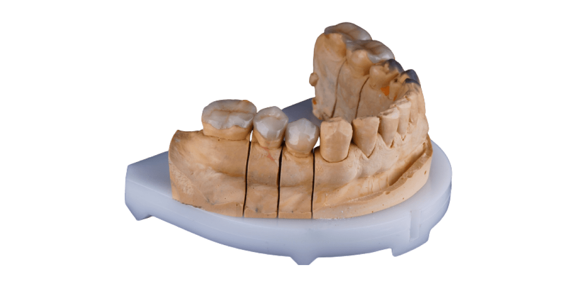 Восстановление зуба вкладками