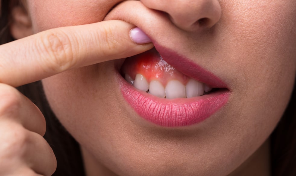 Воспаление десны около зуба